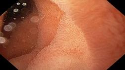 Диагностика целиакии